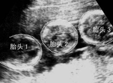 达州有可以做三代试管婴儿的公立医院吗？